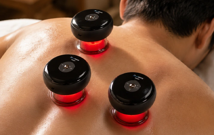Chiropractic Plano TX Cupping Therapy